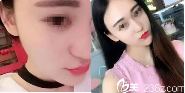 在南京維多利亞找金頌良主任一次注射了8支艾莉薇玻尿酸居然有種網(wǎng)紅小姐姐的既視感