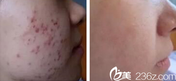 魏翠萍主任痤瘡治療案例 魏翠萍主任痤瘡治療案例