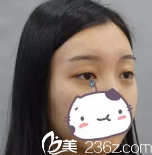 我在大同美神整形醫(yī)院做雙眼皮之前的照片 我在大同美神整形醫(yī)院做雙眼皮之前的照片