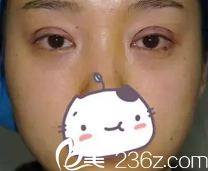 我在大同美神做全切雙眼皮術(shù)后第3天的照片 我在大同美神做全切雙眼皮術(shù)后第3天的照片