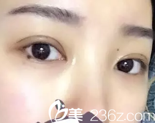 我在大同美神做切開雙眼皮7天拆線的照片 我在大同美神做切開雙眼皮7天拆線的照片