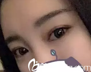 大同整形醫(yī)院哪家好？說(shuō)下我在美神整形做切開(kāi)雙眼皮20天恢復(fù)過(guò)程吧