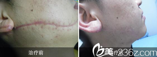 韋志遠(yuǎn)醫(yī)師疤痕修復(fù)案例 韋志遠(yuǎn)醫(yī)師疤痕修復(fù)案例