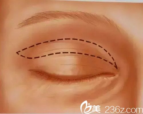 全切雙眼皮手術(shù)過(guò)程 全切雙眼皮手術(shù)過(guò)程