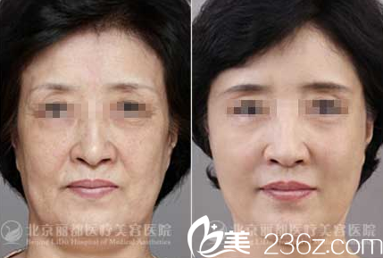 石冰面部年輕化案例 石冰面部年輕化案例