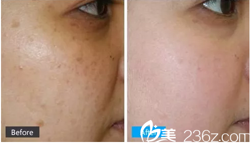 江子旭激光祛斑案例 江子旭激光祛斑案例