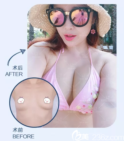 陳萬(wàn)芳自體脂肪豐胸案例 陳萬(wàn)芳自體脂肪豐胸案例