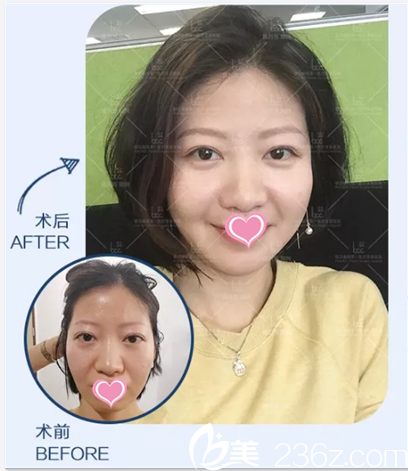 陳萬(wàn)芳自體脂肪面部填充案例 陳萬(wàn)芳自體脂肪面部填充案例