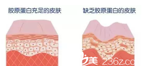 松弛的皮膚結(jié)構(gòu)示意圖 松弛的皮膚結(jié)構(gòu)示意圖
