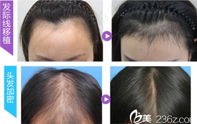 陳善友毛發(fā)移植案例 陳善友毛發(fā)移植案例