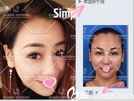 <!--<i data=20240703-sp></i>-->發(fā)際線種植案例