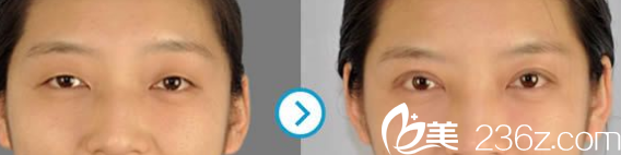 Seven Days整形外科醫(yī)院雙眼皮案例