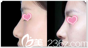 Seven Days整形外科醫(yī)院假體隆鼻案例