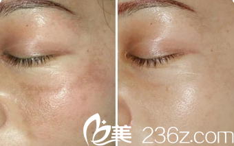 Seven Days整形外科醫(yī)院激光祛斑案例