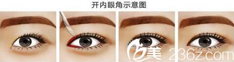 開內(nèi)眼角過(guò)程圖 開內(nèi)眼角過(guò)程圖