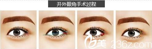 開外眼角過(guò)程示意圖 開外眼角過(guò)程示意圖