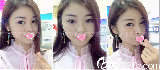 石冰自體脂肪面部填充案例術后30天樣子 石冰自體脂肪面部填充案例術后30天樣子