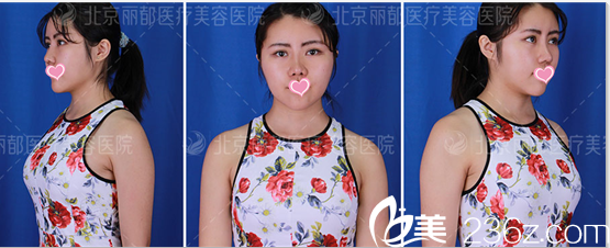 高超自體脂肪豐胸案例術后30天樣子 高超自體脂肪豐胸案例術后30天樣子