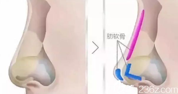 肋軟骨隆鼻手術(shù) 肋軟骨隆鼻手術(shù)