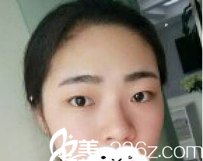 濰坊華美整形美容醫(yī)院任傳琦全切雙眼皮 濰坊華美整形美容醫(yī)院任傳琦全切雙眼皮