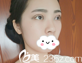 濰坊華美整形美容醫(yī)院任傳琦全切雙眼皮術(shù)后天的眼睛真的好腫 濰坊華美整形美容醫(yī)院任傳琦全切雙眼皮術(shù)后天的眼睛真的好腫