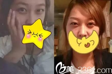 眼鼻整形術(shù)前 眼鼻整形術(shù)前