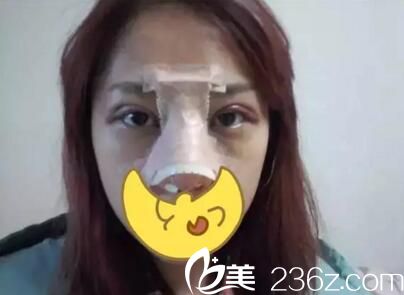 鄭州藝齡張志成做眼鼻整形 鄭州藝齡張志成做眼鼻整形