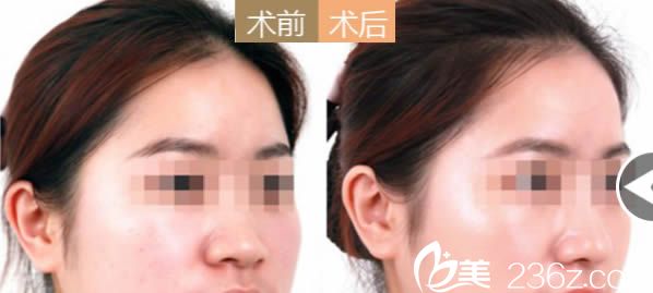 廈門臉博士曾輝武埃菲爾綜合美鼻案例