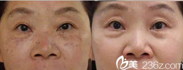 廈門臉博士王珊珊激光祛斑前后對比效果 廈門臉博士王珊珊激光祛斑前后對比效果