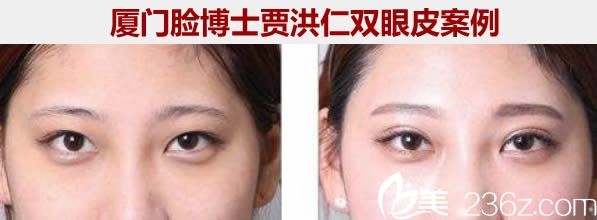 廈門臉博士整形醫(yī)院賈洪仁雙眼皮案例圖