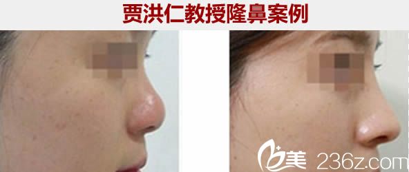 廈門臉博士賈洪仁鼻綜合隆鼻一年后恢復效果