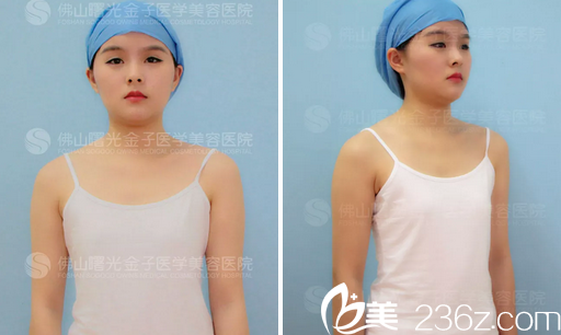 來(lái)佛山曙光金子隆胸前的照片 來(lái)佛山曙光金子隆胸前的照片