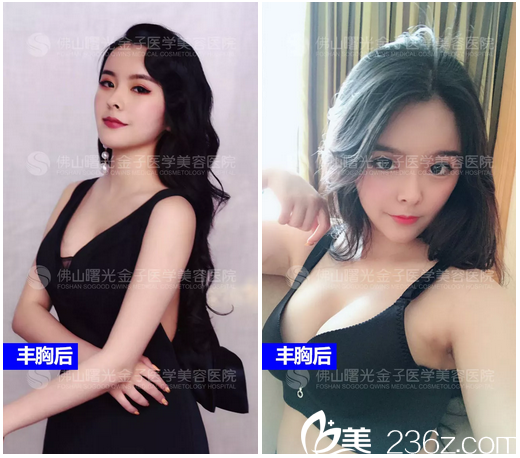 佛山曙光金子何宜新隆胸案例術(shù)后寫(xiě)真圖片 佛山曙光金子何宜新隆胸案例術(shù)后寫(xiě)真圖片