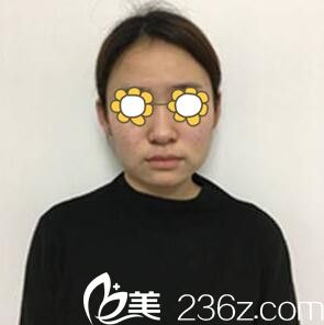 下頜角整形術(shù)前照 下頜角整形術(shù)前照