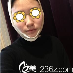 輪廓整形術(shù)后3天效果 輪廓整形術(shù)后3天效果