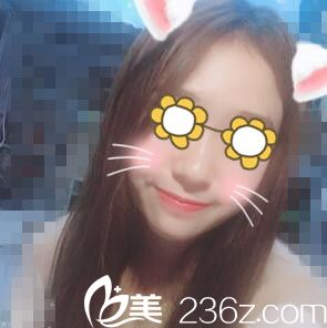 在美貪做下頜角術(shù)后1個月效果 在美貪做下頜角術(shù)后1個月效果