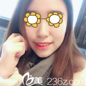 找韓國美貪整形醫(yī)院金光泰做下頜角術(shù)后兩個(gè)月效果分享 大方臉變小V臉