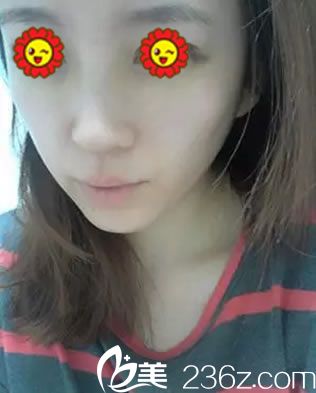 在臺州維多利亞做隆鼻術(shù)后30天 在臺州維多利亞做隆鼻術(shù)后30天