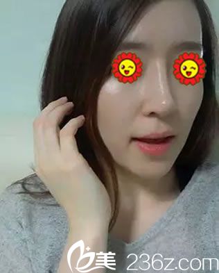 我的鼻子往下塌好難看選擇臺(tái)州維多利亞找常文彥主任做鼻綜合隆鼻來蛻變