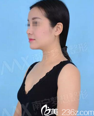 在南寧夢想做假體隆胸手術(shù)前拍照 在南寧夢想做假體隆胸手術(shù)前拍照