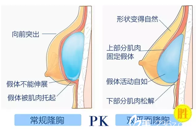 在南寧夢想做假體隆胸手術(shù)優(yōu)勢 在南寧夢想做假體隆胸手術(shù)優(yōu)勢