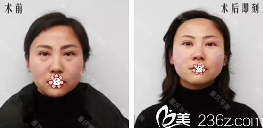 重慶華美激光祛眼袋術前術后對比