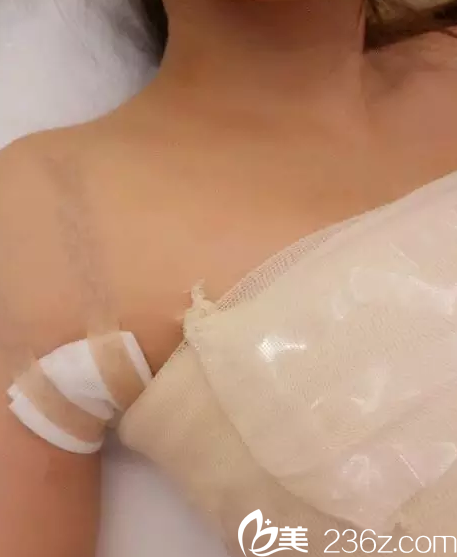 在南寧東方做假體隆胸手術(shù)后1天 在南寧東方做假體隆胸手術(shù)后1天