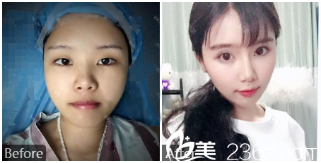 <!--<i data=20240703-sp></li>
<li><i data=20240703-sp></i>-->雙眼皮隆鼻案例