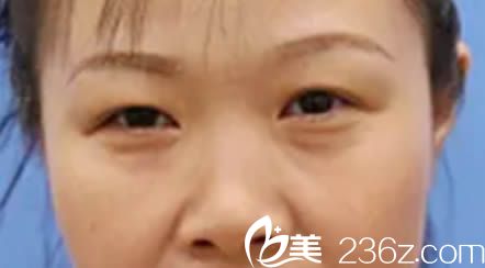 在廈門臉博士整形醫(yī)院做眼鼻整形術(shù)前照 在廈門臉博士整形醫(yī)院做眼鼻整形術(shù)前照