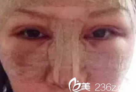 做完雙眼皮和假體隆鼻第2天的樣子 做完雙眼皮和假體隆鼻第2天的樣子