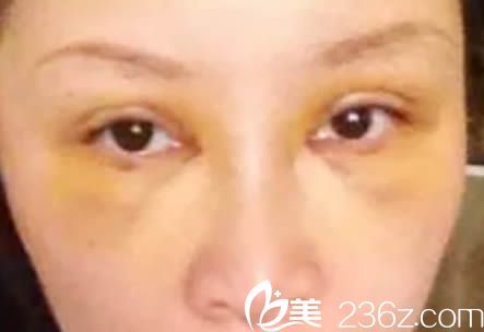 雙眼皮和隆鼻第7天拆線后的照片 雙眼皮和隆鼻第7天拆線后的照片