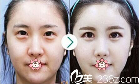 樸炳浩院長眼底脂肪祛除案例 樸炳浩院長眼底脂肪祛除案例