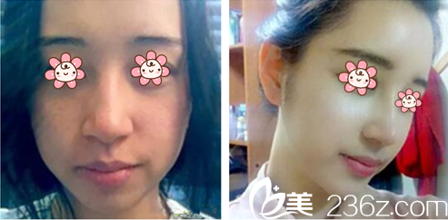 徐東麟院長隆鼻案例 徐東麟院長隆鼻案例