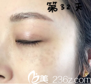 可能因為我的斑點顏色比較重吧